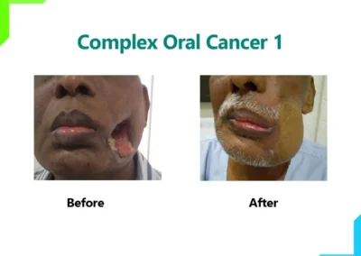 Complex Oral Cancer - 1