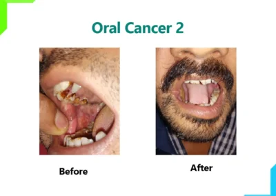 Oral Cancer - 2