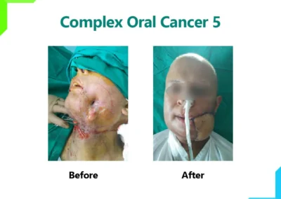 Complex Oral Cancer 5