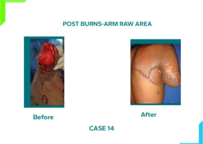 Post Burn Arm Raw Area