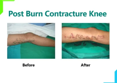 Post Burn contracture knee