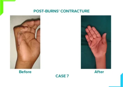 Post Burns Contracture