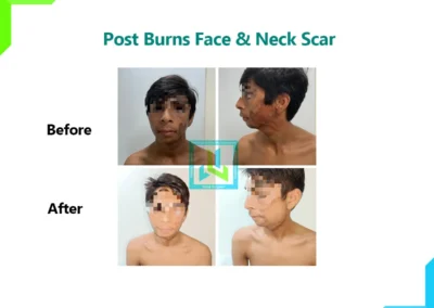 Post Burns Face and neck scar