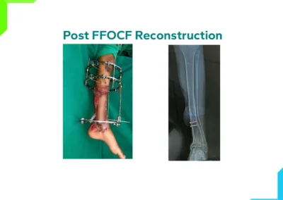 Post FFOCF Reconstruction