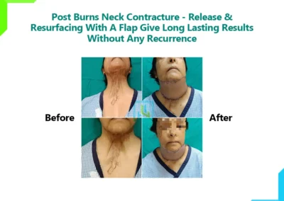 Post burns neck contracture