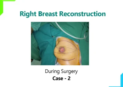 Right Breast Reconstruction Case-2