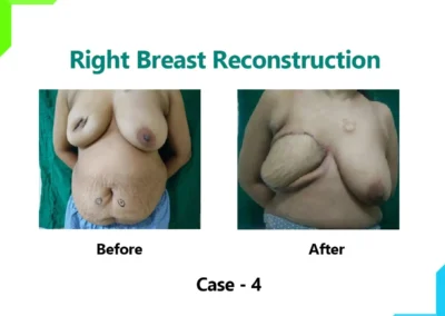 Right Breast Reconstruction Case-4