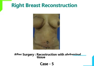 Right Breast Reconstruction Case-5