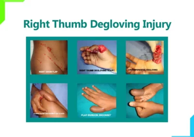 Right Thumb degloving injury