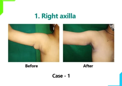 Right axilla Case-1