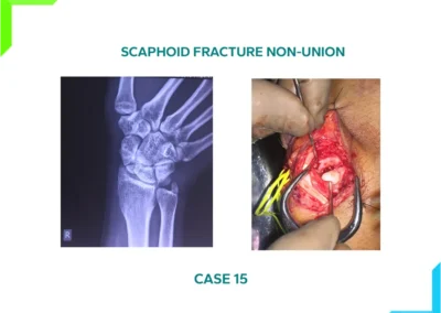 Scaphoid Fracture Non Union