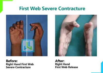 First Web Severe Contracture