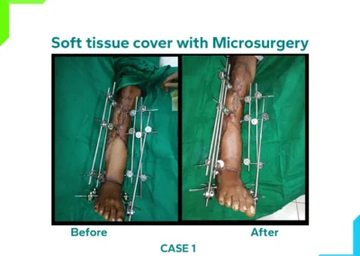 Bony reconstruction with microsurgery Case 1
