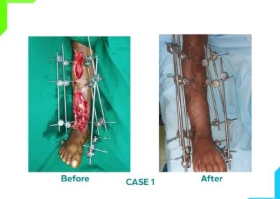 Bony reconstruction with microsurgery Case 1