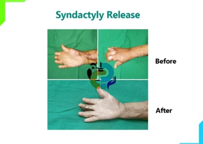 Syndactyly Release