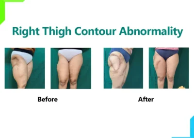 Thigh Contour Abnormal