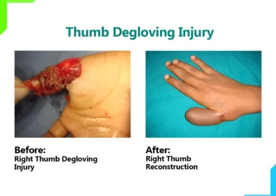 Thumb Degloving Injury