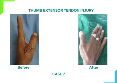 Thumb Extensor Tendon Injury