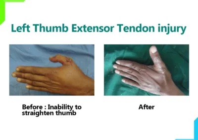 Thumb extensor tendon injury