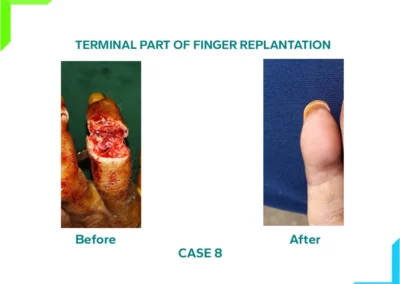 Thumbnail Part of finger replantation