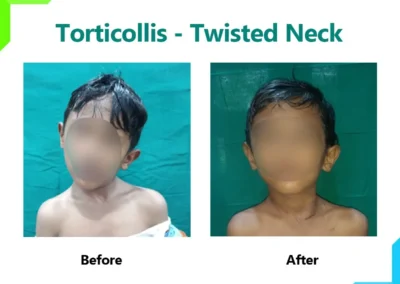 Torticollis - Twisted Neck
