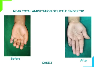 Little finger near total amputation