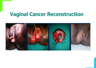 Vaginal Cancer Reconstruction