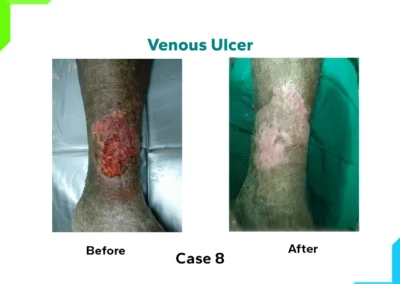 Venous Ulcer