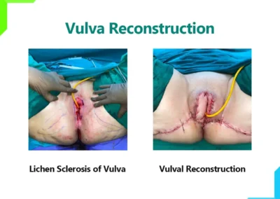 Vulva Reconstruction