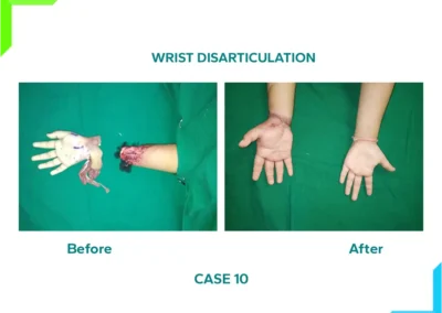 Wrist Disarticulation