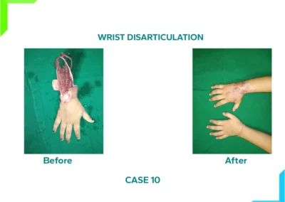 Wrist Disarticulation
