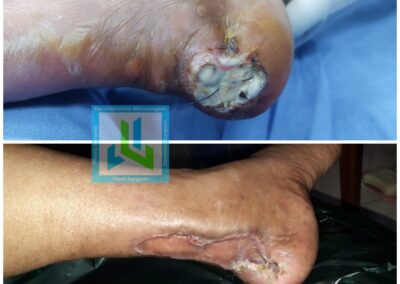 Diabetic Foot Ulcer Surgery