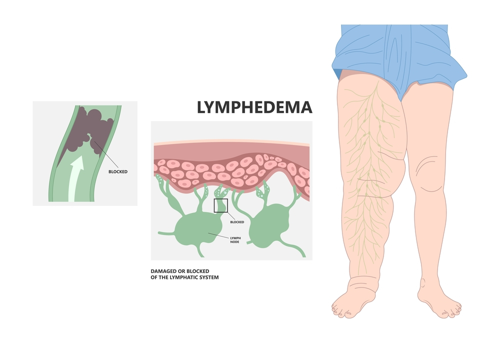 Lymphedema Treatment