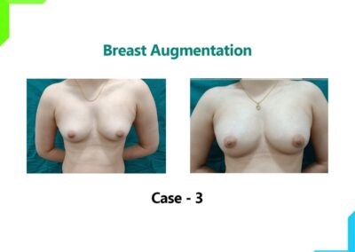 Breast Augmentation Case-3