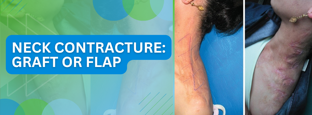 NECK CONTRACTURE: GRAFT OR FLAP
