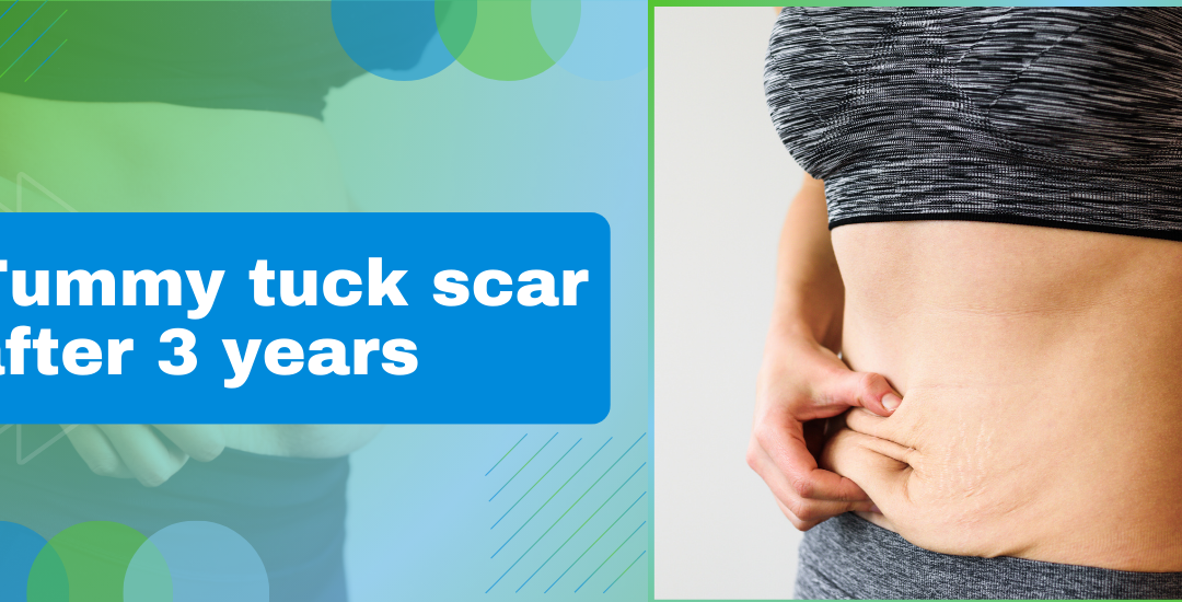Tummy tuck scar