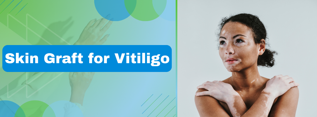 Skin Graft for Vitiligo